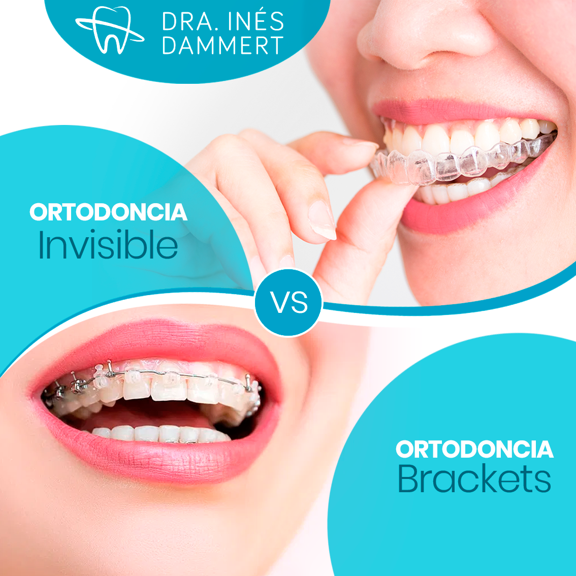 ortodoncia invisible vs Brackets
